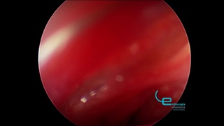 Риноскопия у кошки / Rinoscopia: exploracin completa cavidad nasal derecha