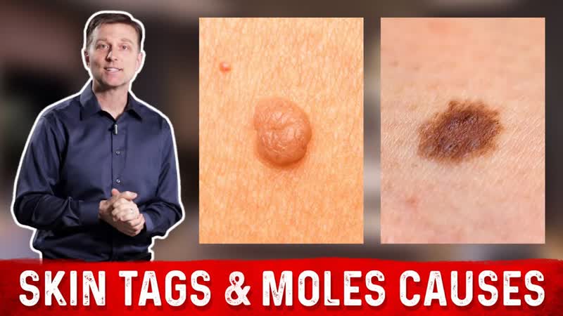 What Causes Skin Tags and
