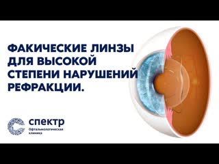 Факичные линзы для коррекции зрения высокой степени нарушений рефракции.